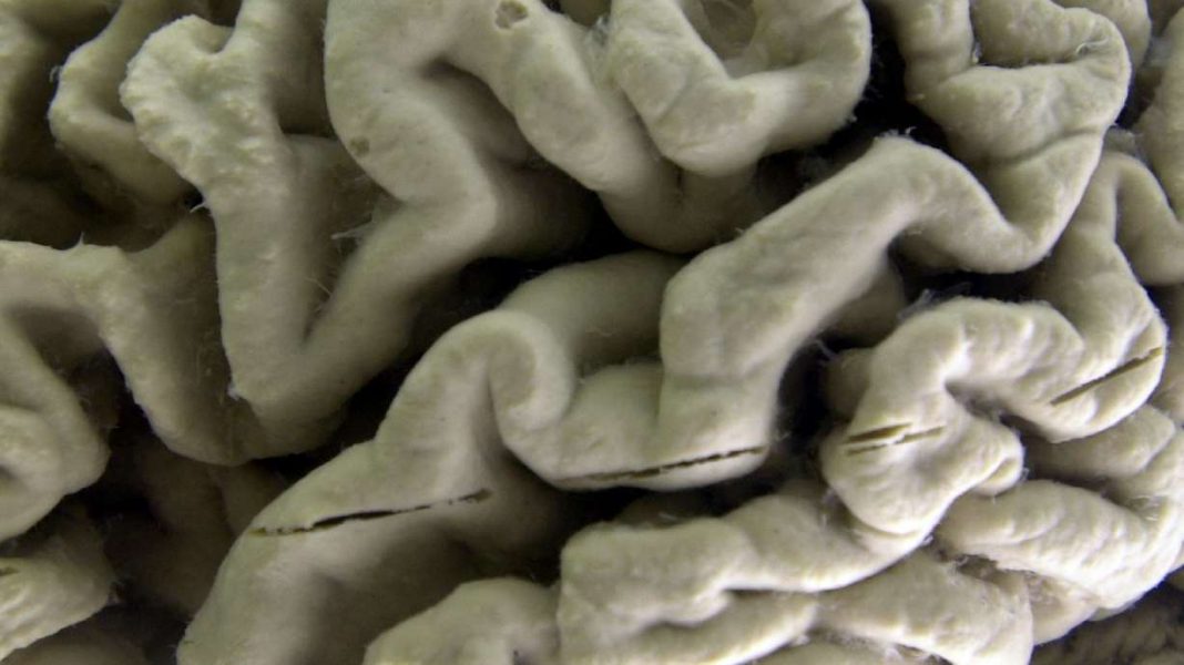 Study Reveals Alzheimer’s Damages the Brain Prior to Symptom Onset